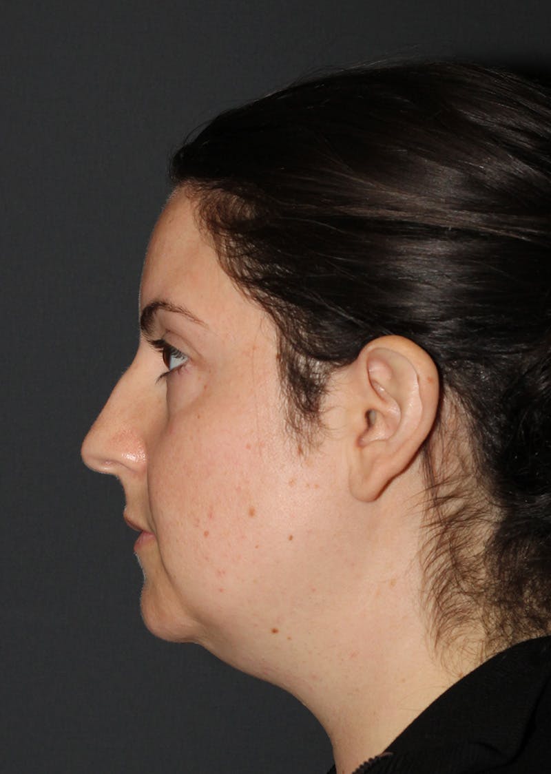 Facetite Before & After Gallery - Patient 110367 - Image 9