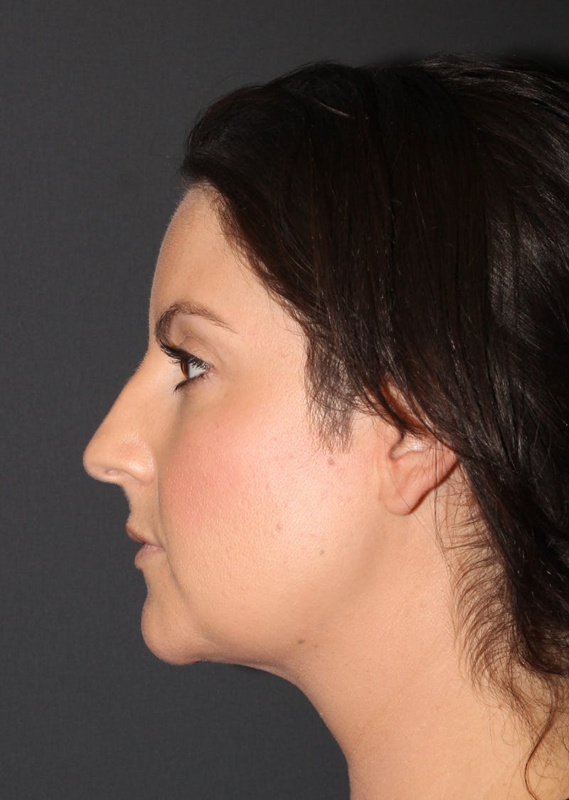Facetite Before & After Gallery - Patient 110367 - Image 10
