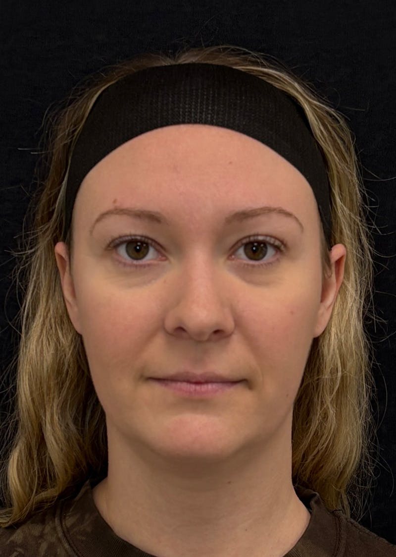 Facetite Before & After Gallery - Patient 270770 - Image 5