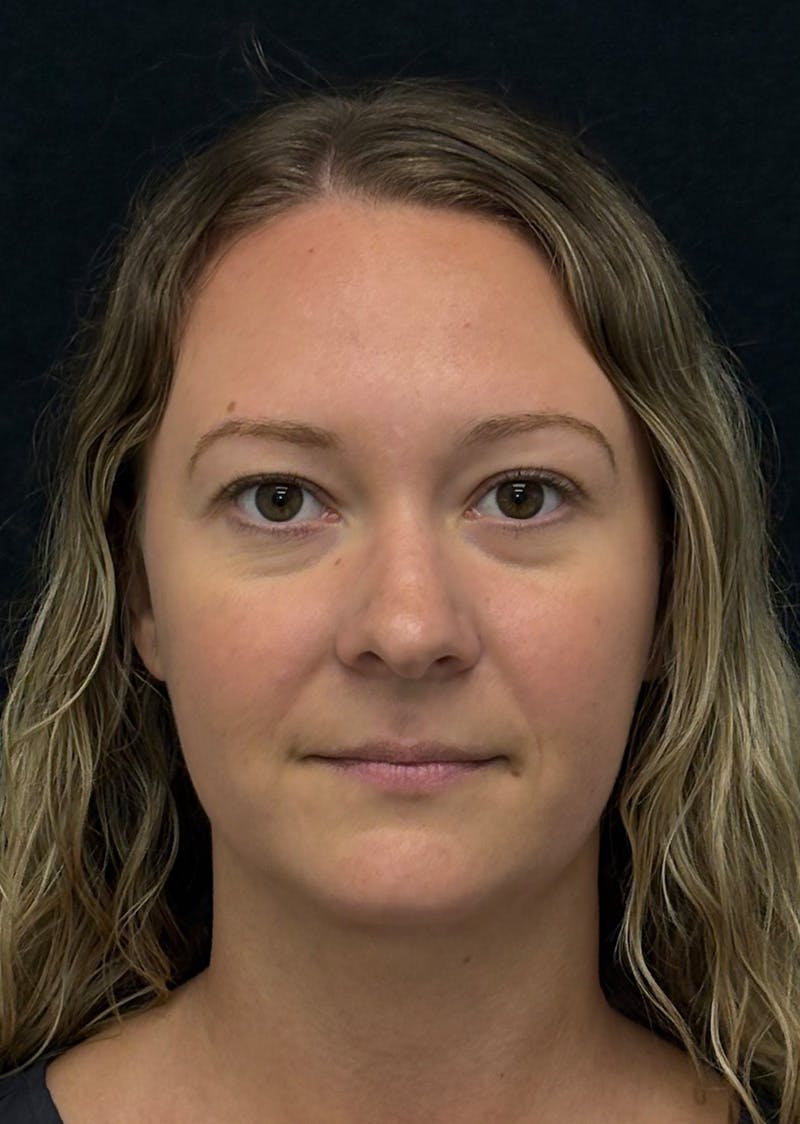 Facetite Before & After Gallery - Patient 270770 - Image 6