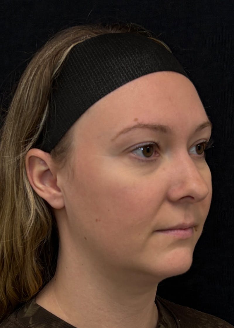 Facetite Before & After Gallery - Patient 270770 - Image 3