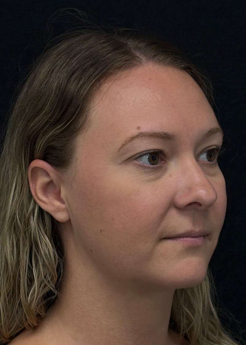 Facetite Before & After Gallery - Patient 270770 - Image 4