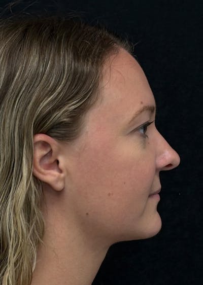 Facetite Before & After Gallery - Patient 270770 - Image 2
