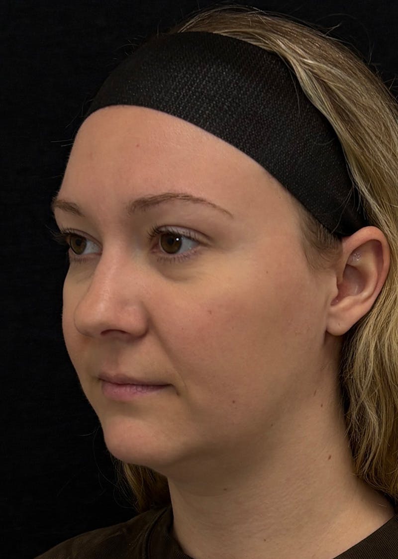 Facetite Before & After Gallery - Patient 270770 - Image 7