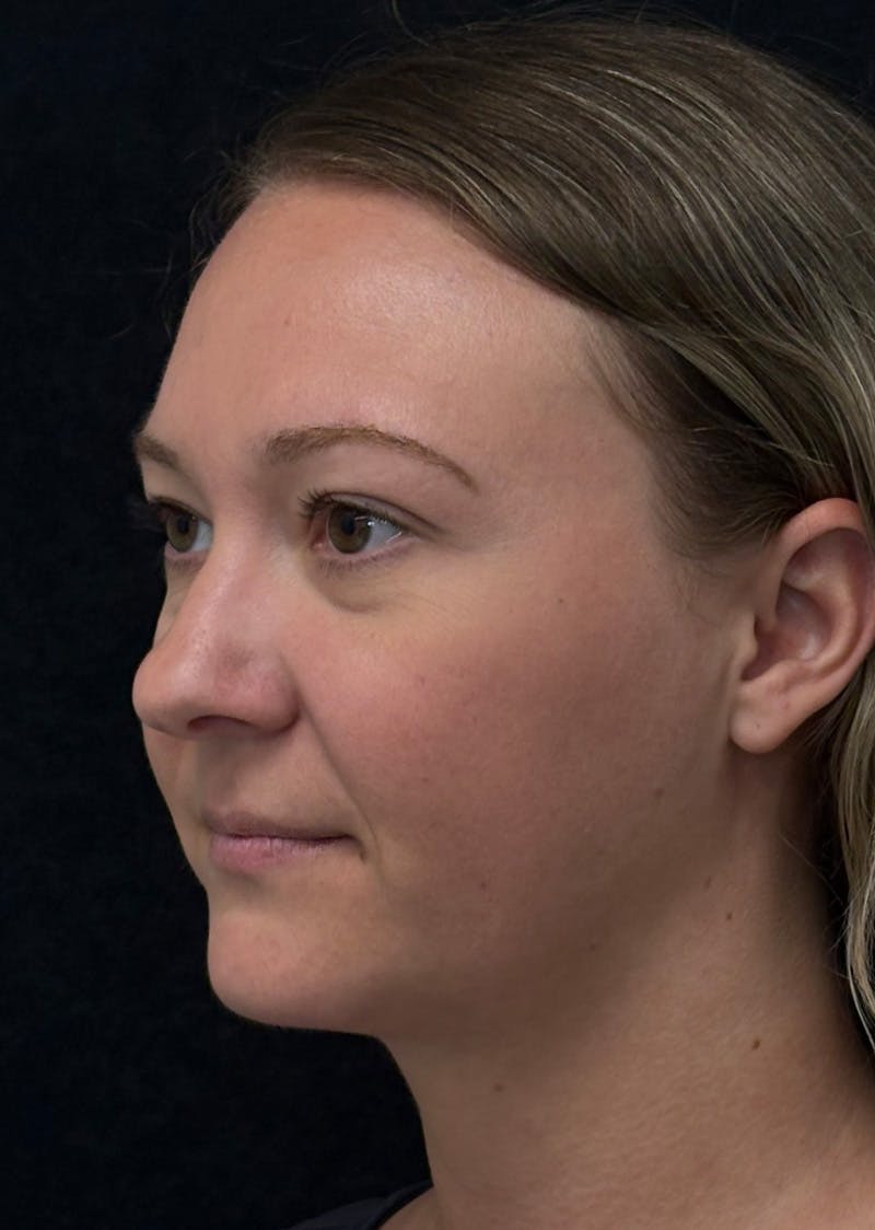Facetite Before & After Gallery - Patient 270770 - Image 8