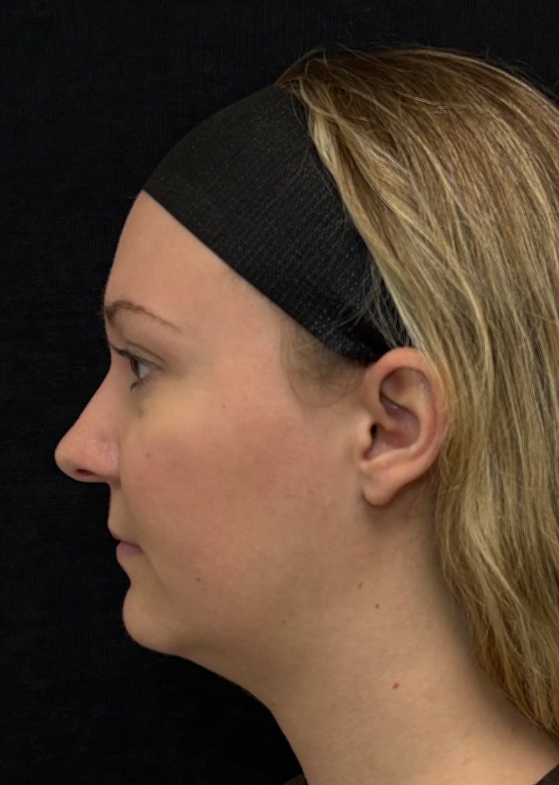 Facetite Before & After Gallery - Patient 270770 - Image 9