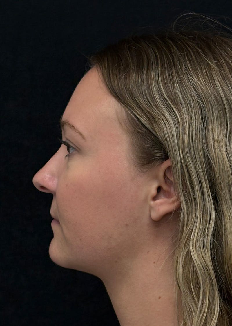 Facetite Before & After Gallery - Patient 270770 - Image 10