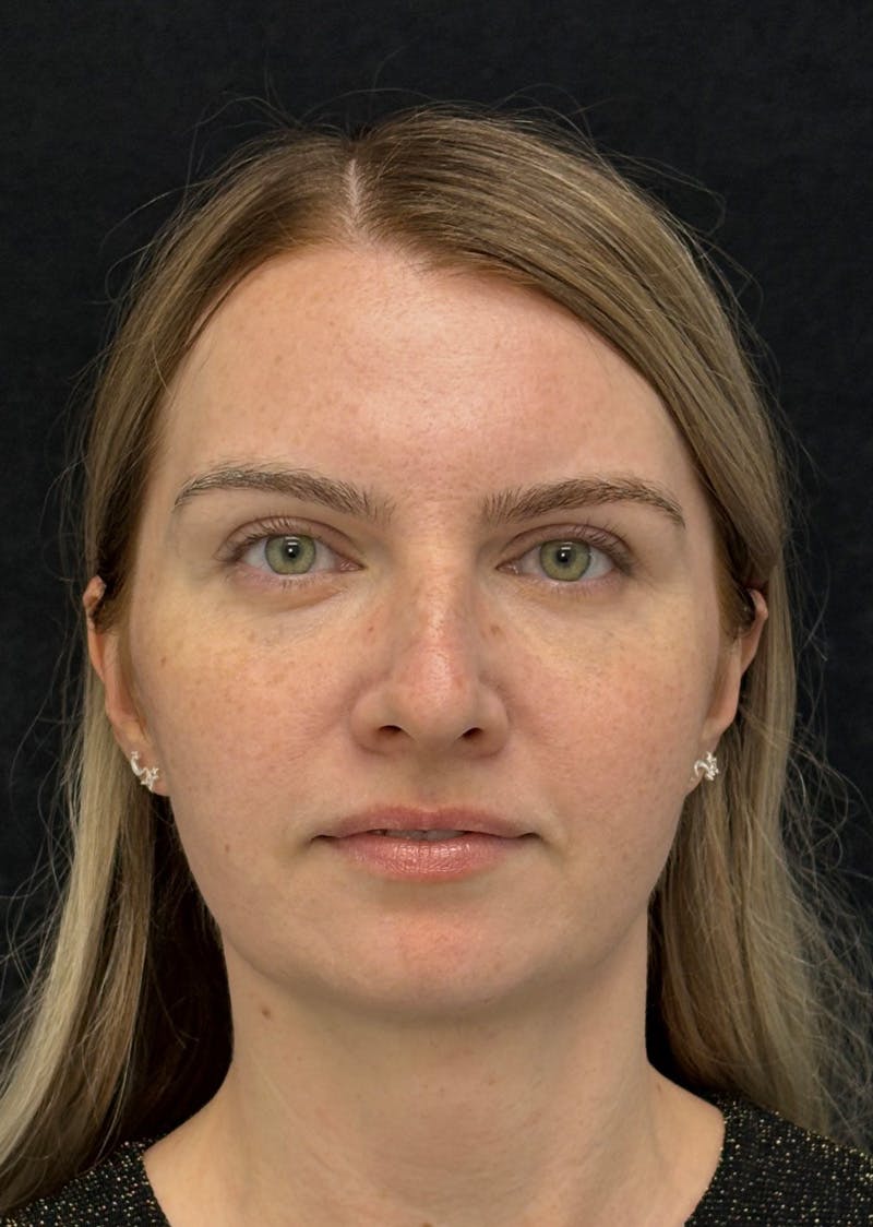 Facetite Before & After Gallery - Patient 356452 - Image 6