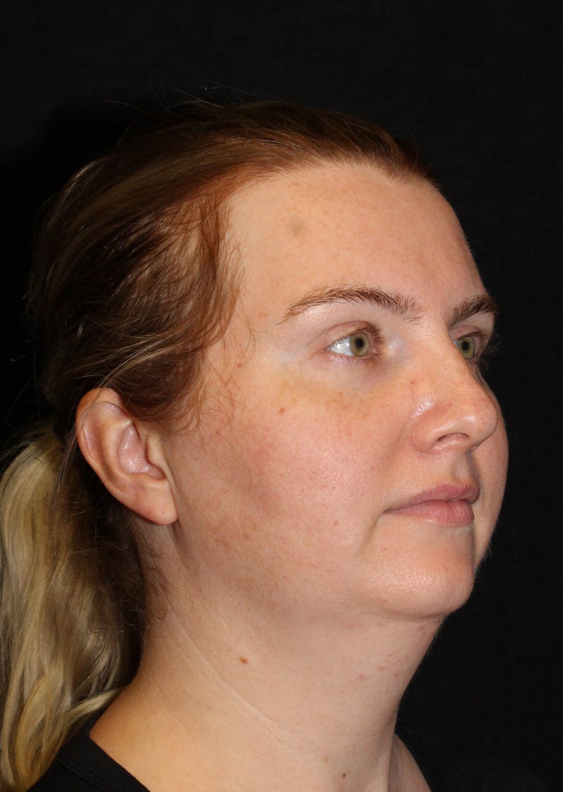 Facetite Before & After Gallery - Patient 356452 - Image 3