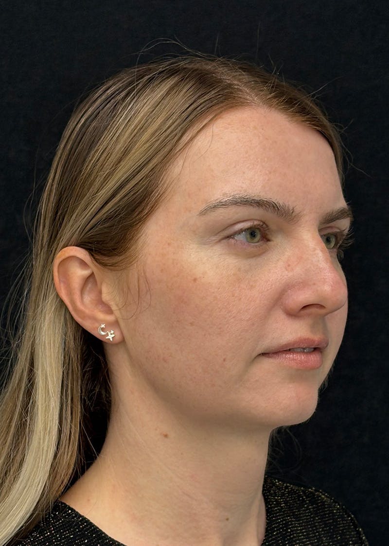Facetite Before & After Gallery - Patient 356452 - Image 4