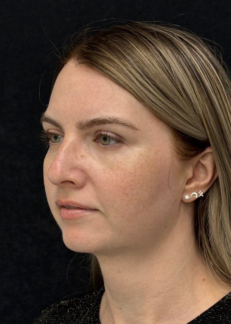Facetite Before & After Gallery - Patient 356452 - Image 8