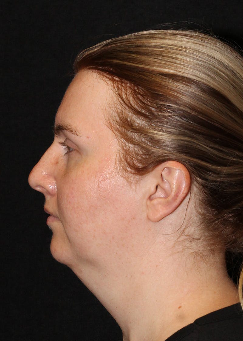 Facetite Before & After Gallery - Patient 356452 - Image 9