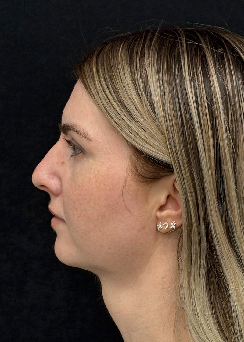Facetite Before & After Gallery - Patient 356452 - Image 10