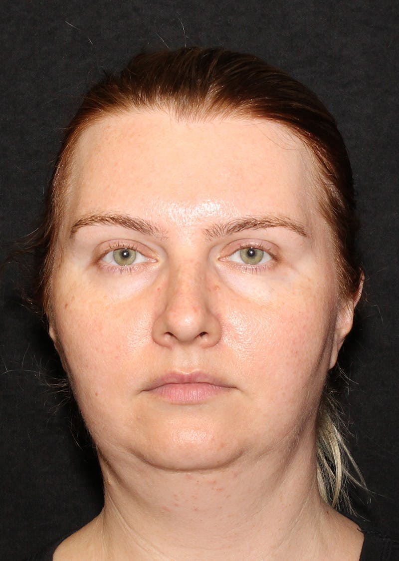 Facetite Before & After Gallery - Patient 356452 - Image 5