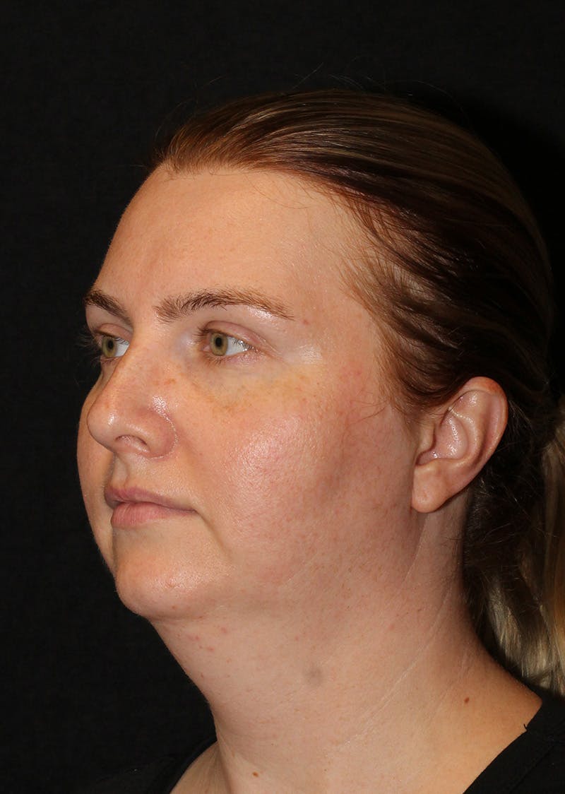 Facetite Before & After Gallery - Patient 356452 - Image 7
