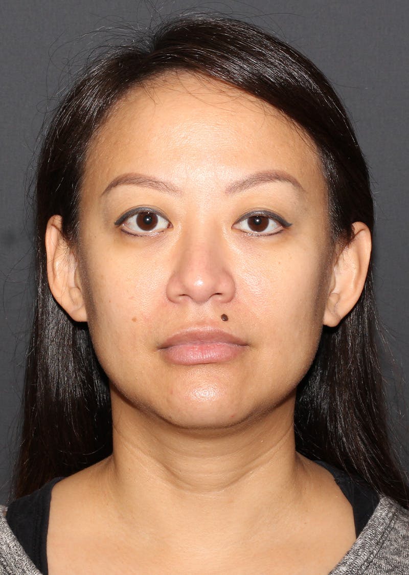 Facetite Before & After Gallery - Patient 209387 - Image 5