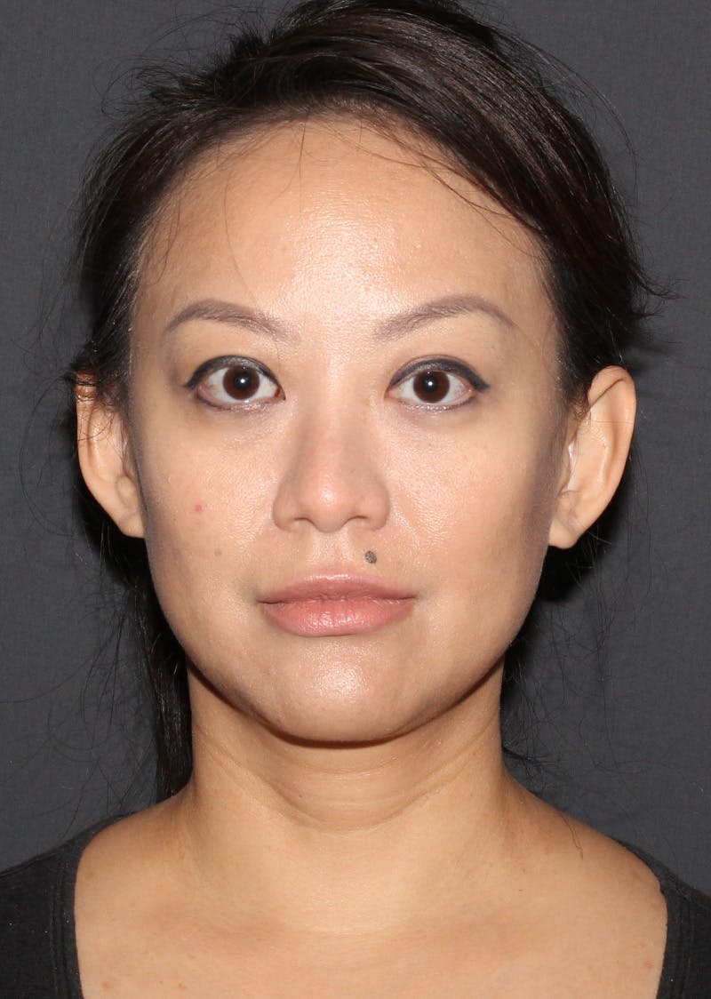 Facetite Before & After Gallery - Patient 209387 - Image 6