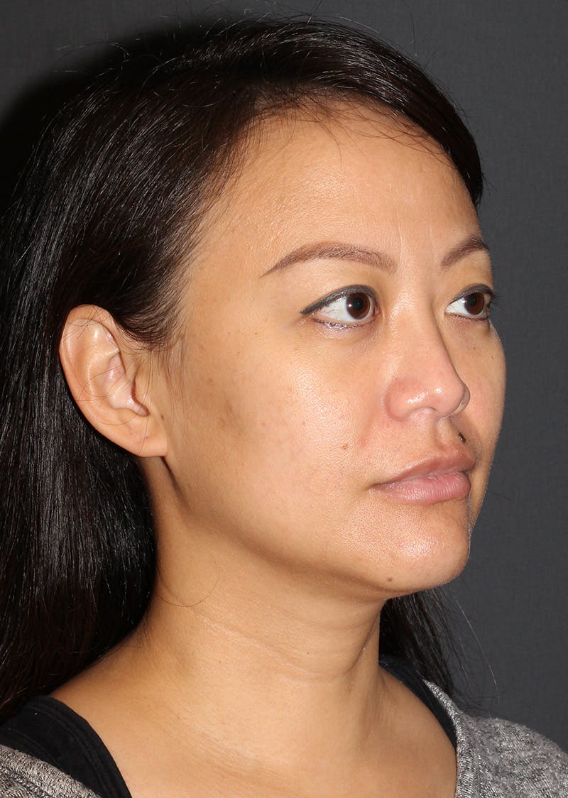 Facetite Before & After Gallery - Patient 209387 - Image 3