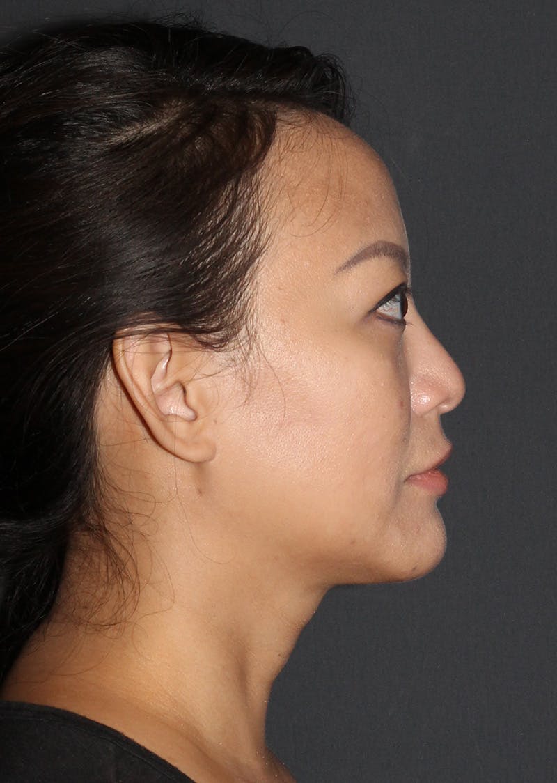 Facetite Before & After Gallery - Patient 209387 - Image 2