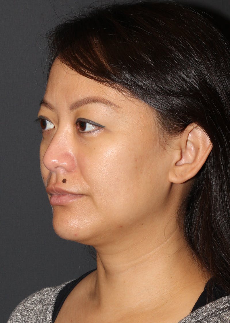 Facetite Before & After Gallery - Patient 209387 - Image 7