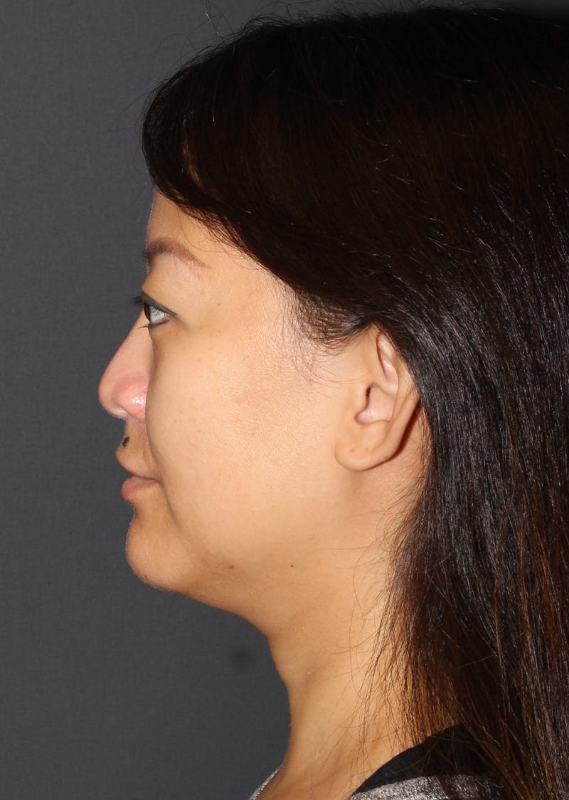 Facetite Before & After Gallery - Patient 209387 - Image 9