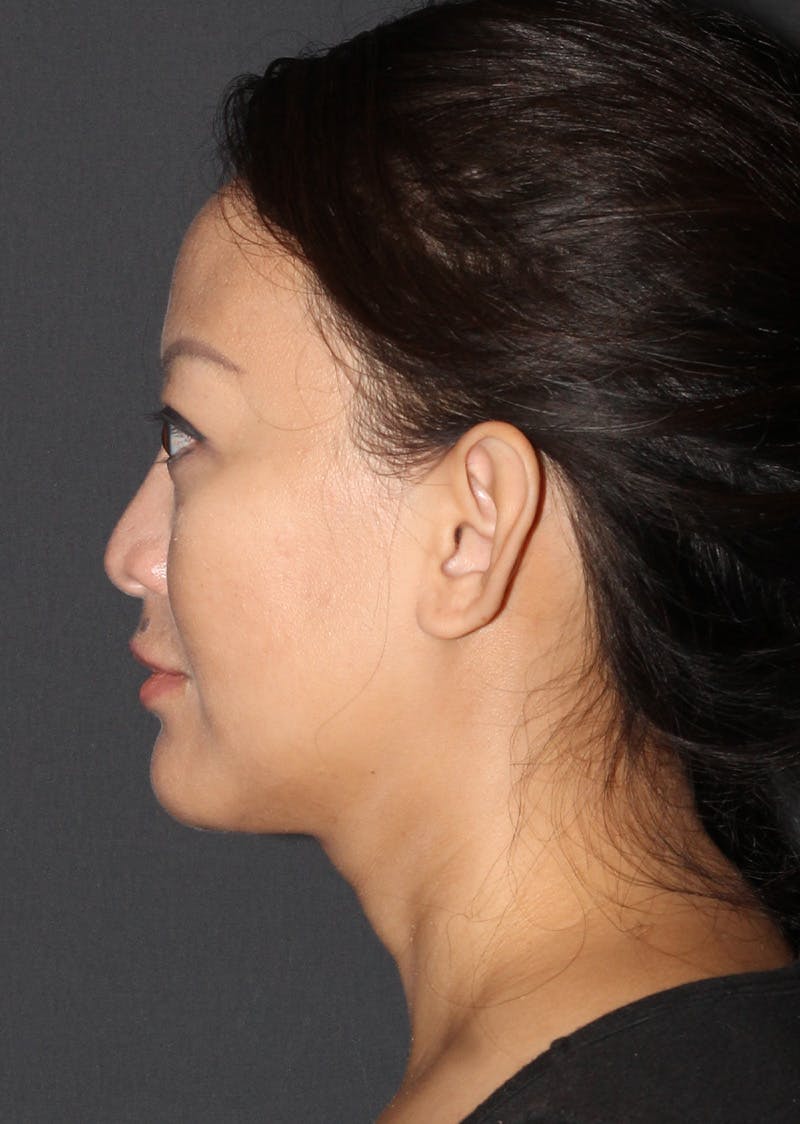 Facetite Before & After Gallery - Patient 209387 - Image 10