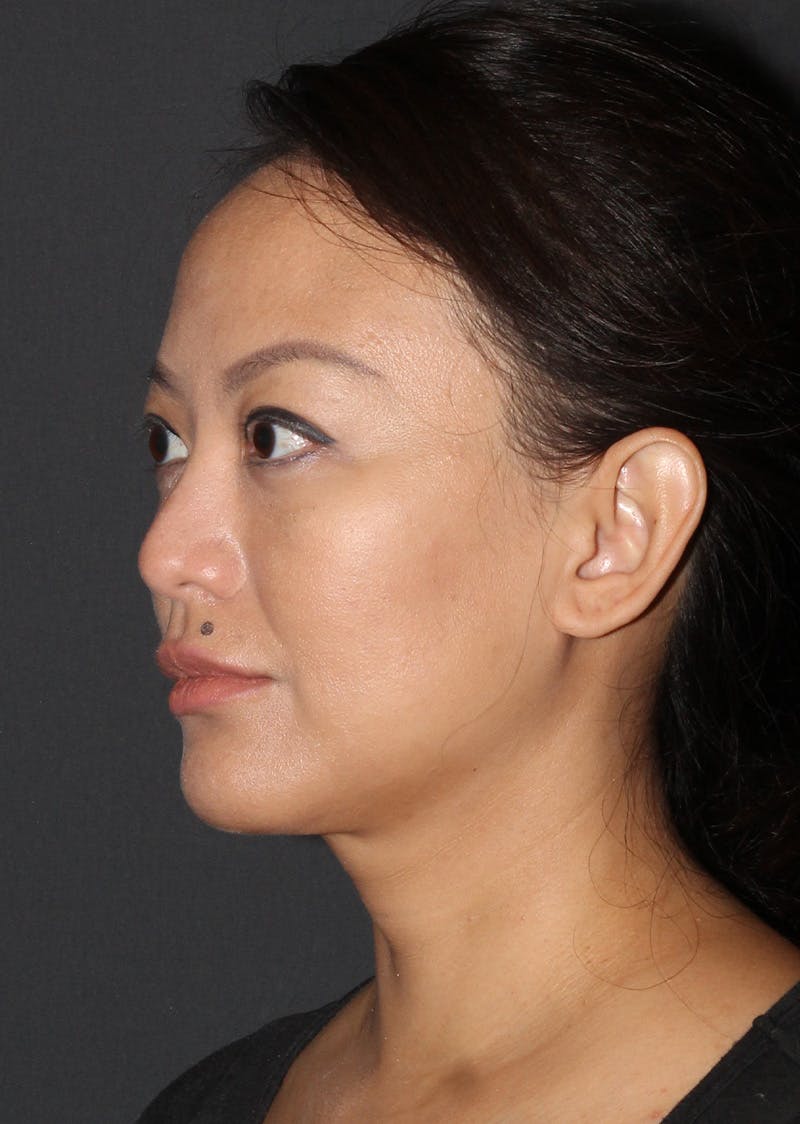 Facetite Before & After Gallery - Patient 209387 - Image 8