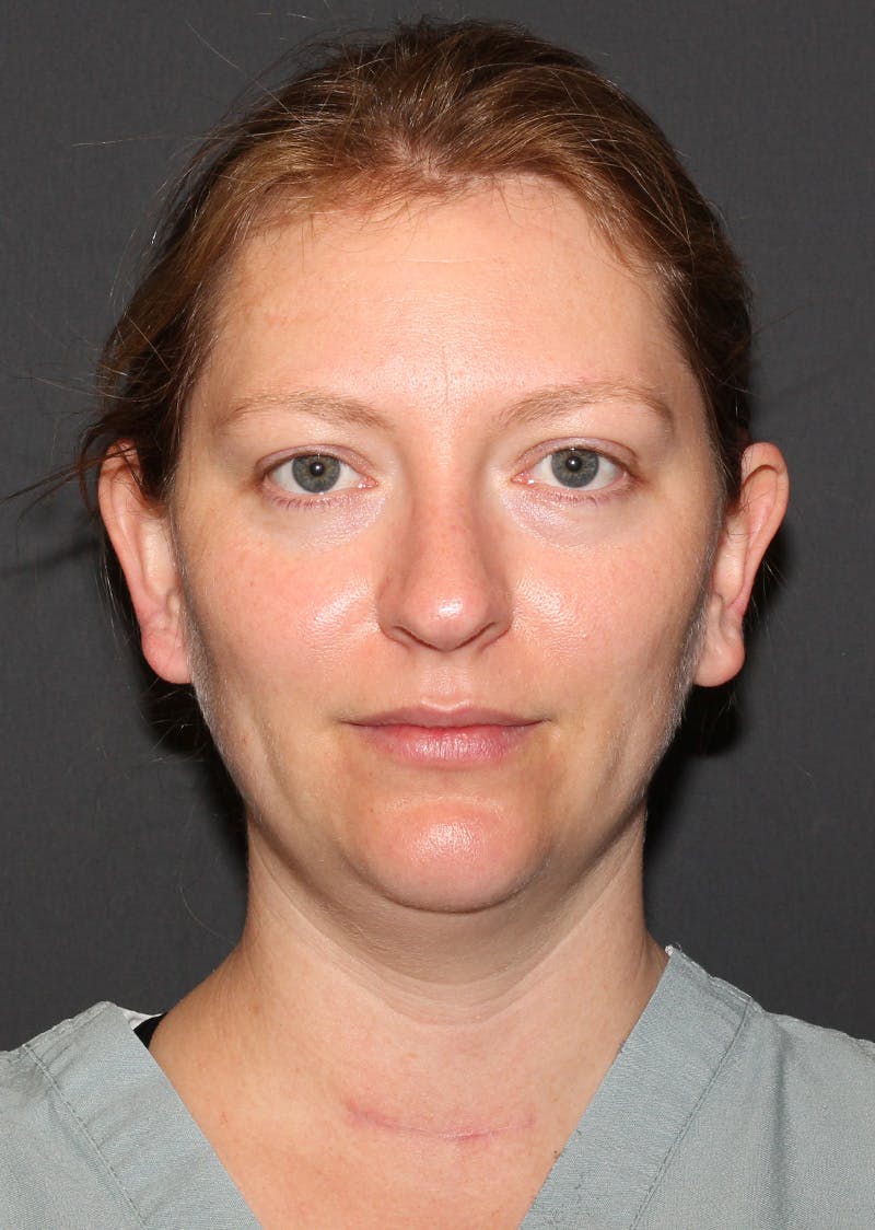 Facetite Before & After Gallery - Patient 228350 - Image 5