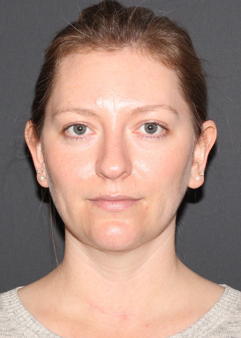 Facetite Before & After Gallery - Patient 228350 - Image 6