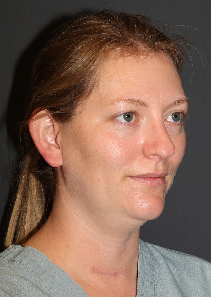 Facetite Before & After Gallery - Patient 228350 - Image 3