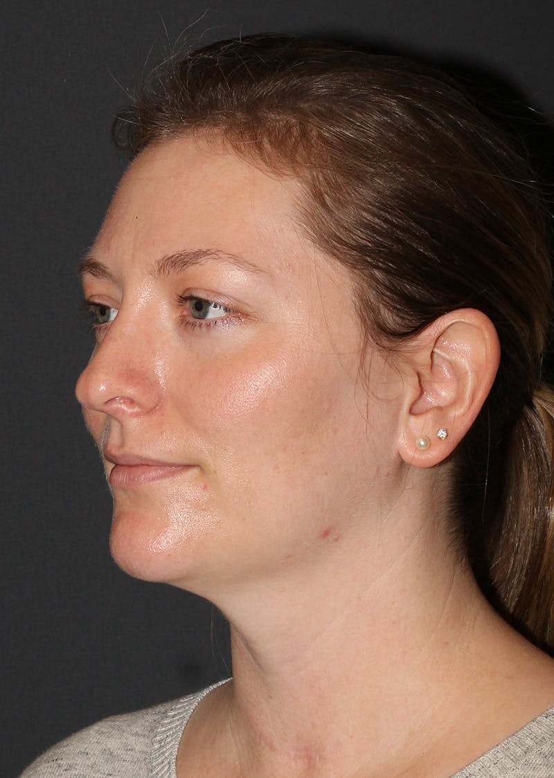 Facetite Before & After Gallery - Patient 228350 - Image 8