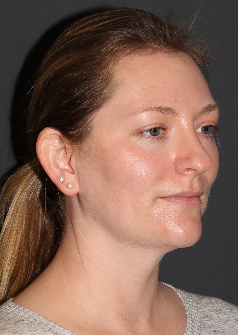 Facetite Before & After Gallery - Patient 228350 - Image 4