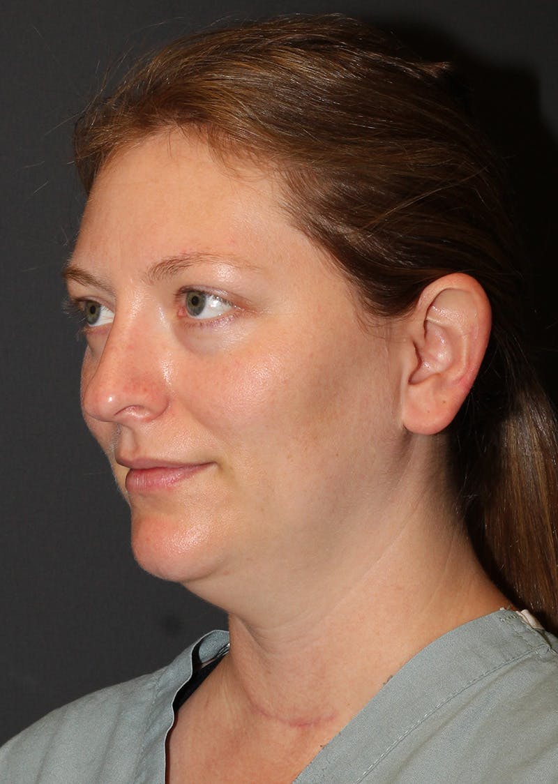 Facetite Before & After Gallery - Patient 228350 - Image 7