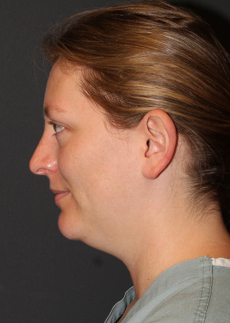 Facetite Before & After Gallery - Patient 228350 - Image 9