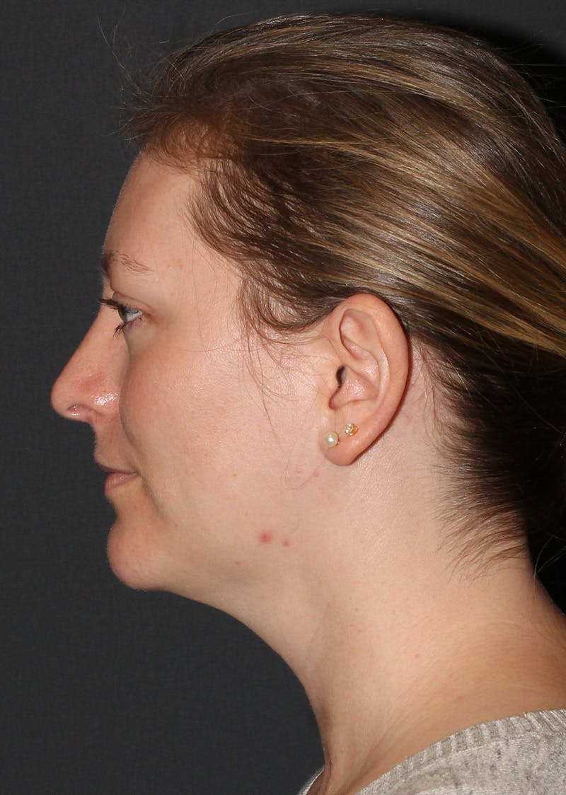 Facetite Before & After Gallery - Patient 228350 - Image 10