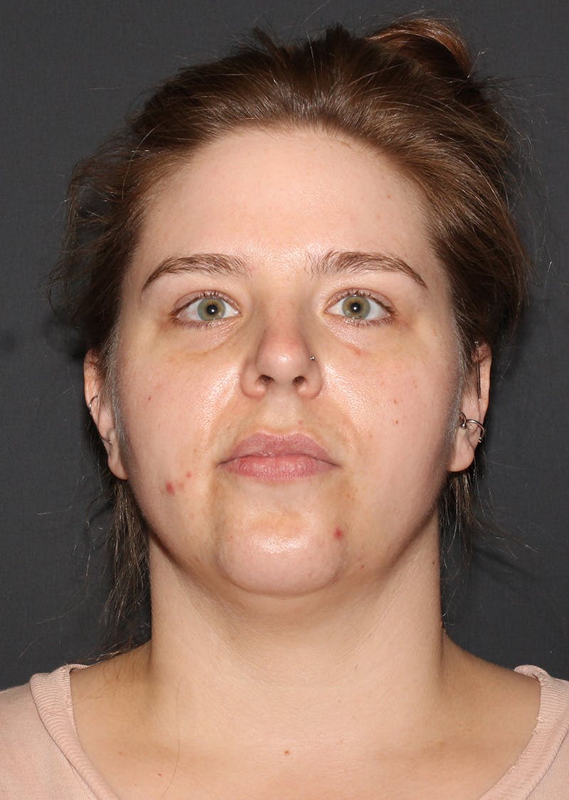 Facetite Before & After Gallery - Patient 154656 - Image 5