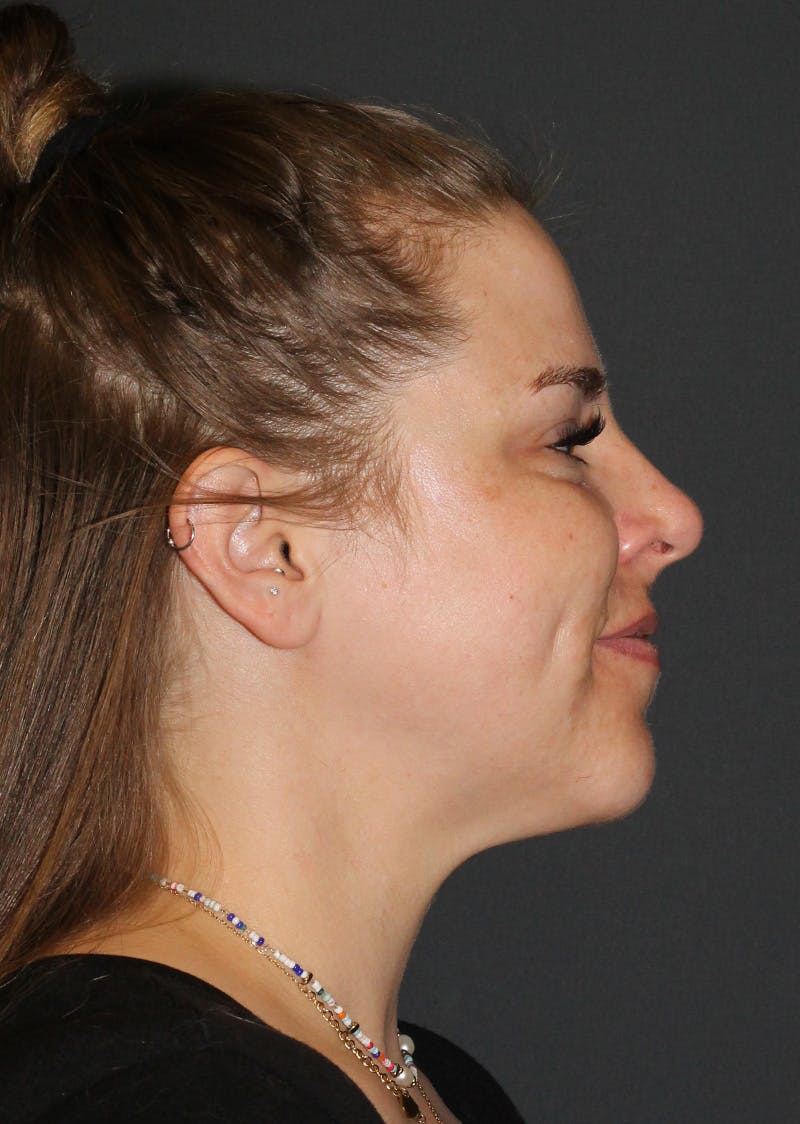 Facetite Before & After Gallery - Patient 154656 - Image 2