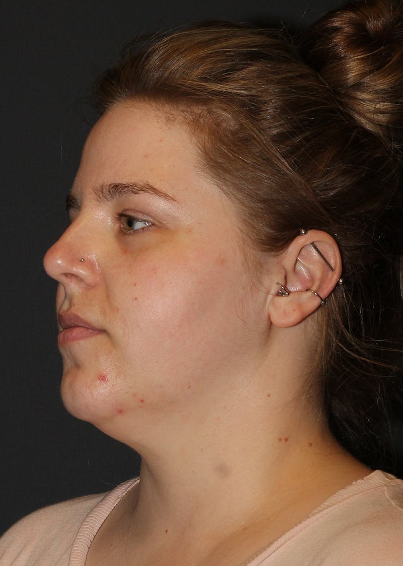 Facetite Before & After Gallery - Patient 154656 - Image 7