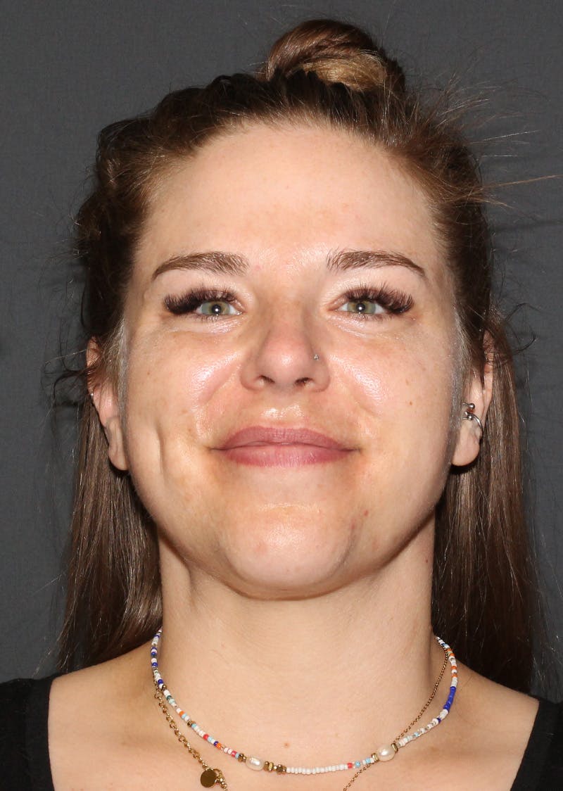 Facetite Before & After Gallery - Patient 154656 - Image 6