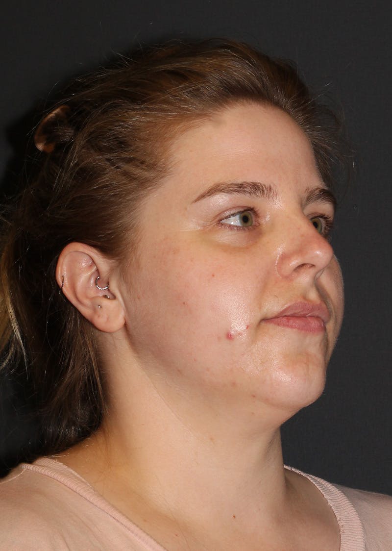 Facetite Before & After Gallery - Patient 154656 - Image 3