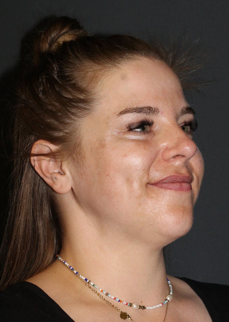 Facetite Before & After Gallery - Patient 154656 - Image 4