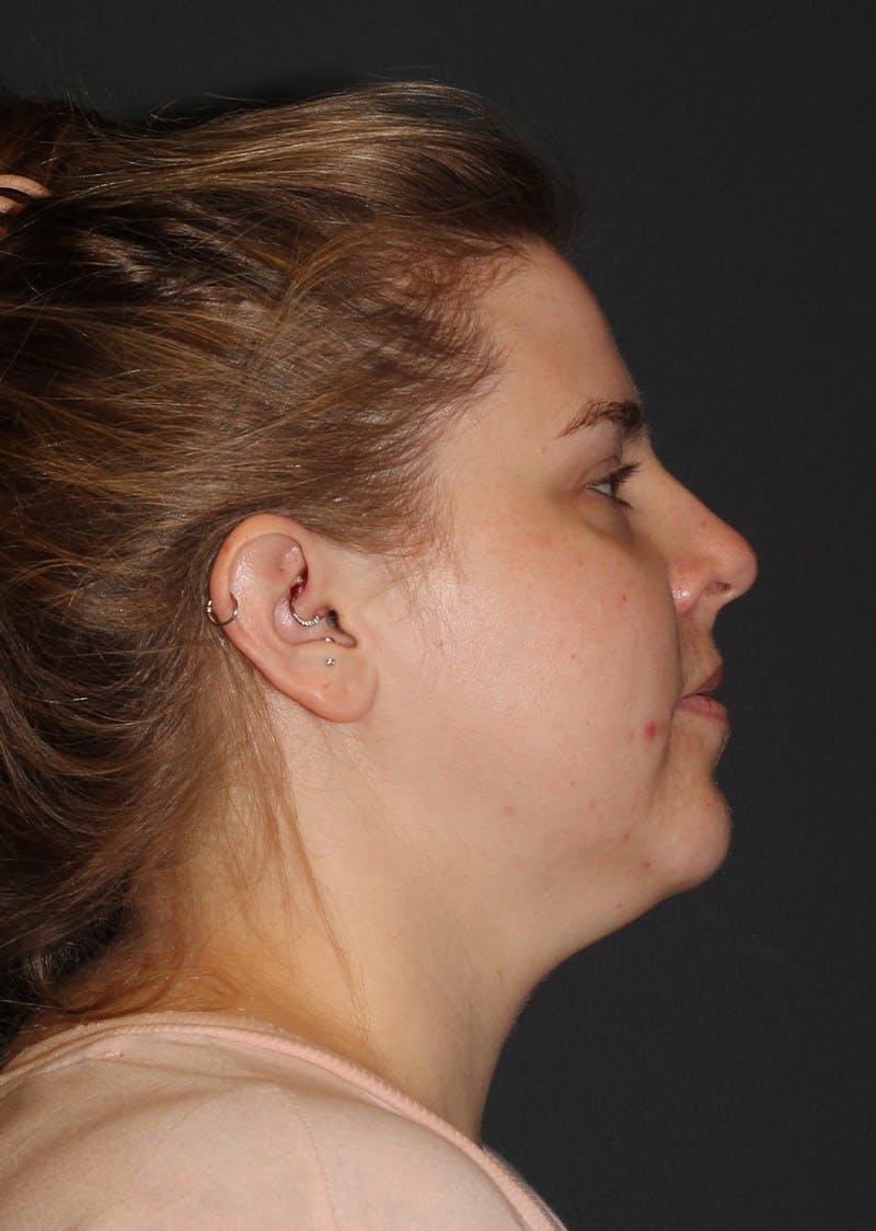 Facetite Before & After Gallery - Patient 154656 - Image 1