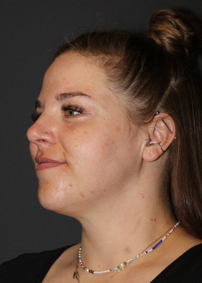 Facetite Before & After Gallery - Patient 154656 - Image 8
