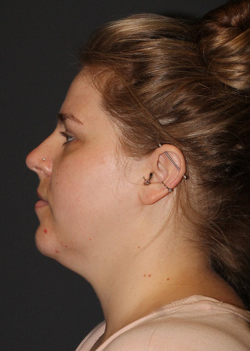 Facetite Before & After Gallery - Patient 154656 - Image 9