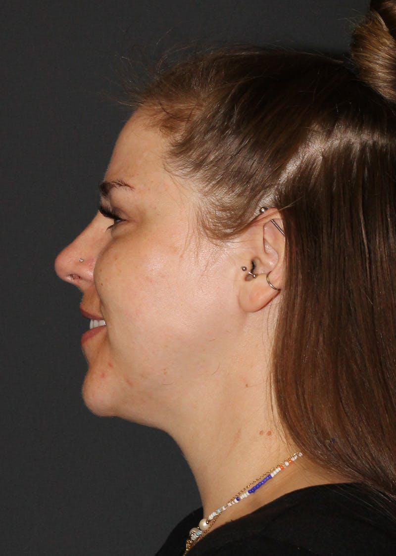 Facetite Before & After Gallery - Patient 154656 - Image 10