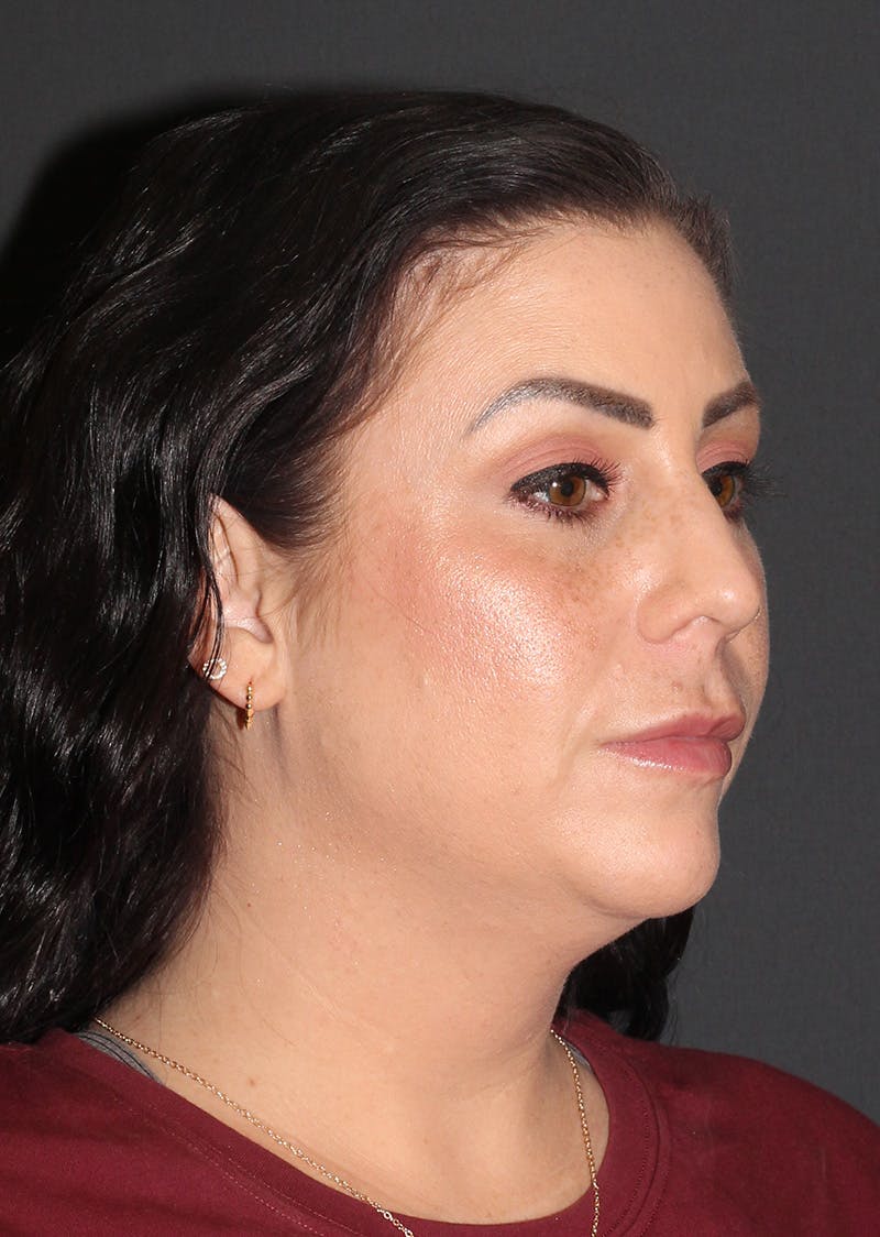 Facetite Before & After Gallery - Patient 325510 - Image 3
