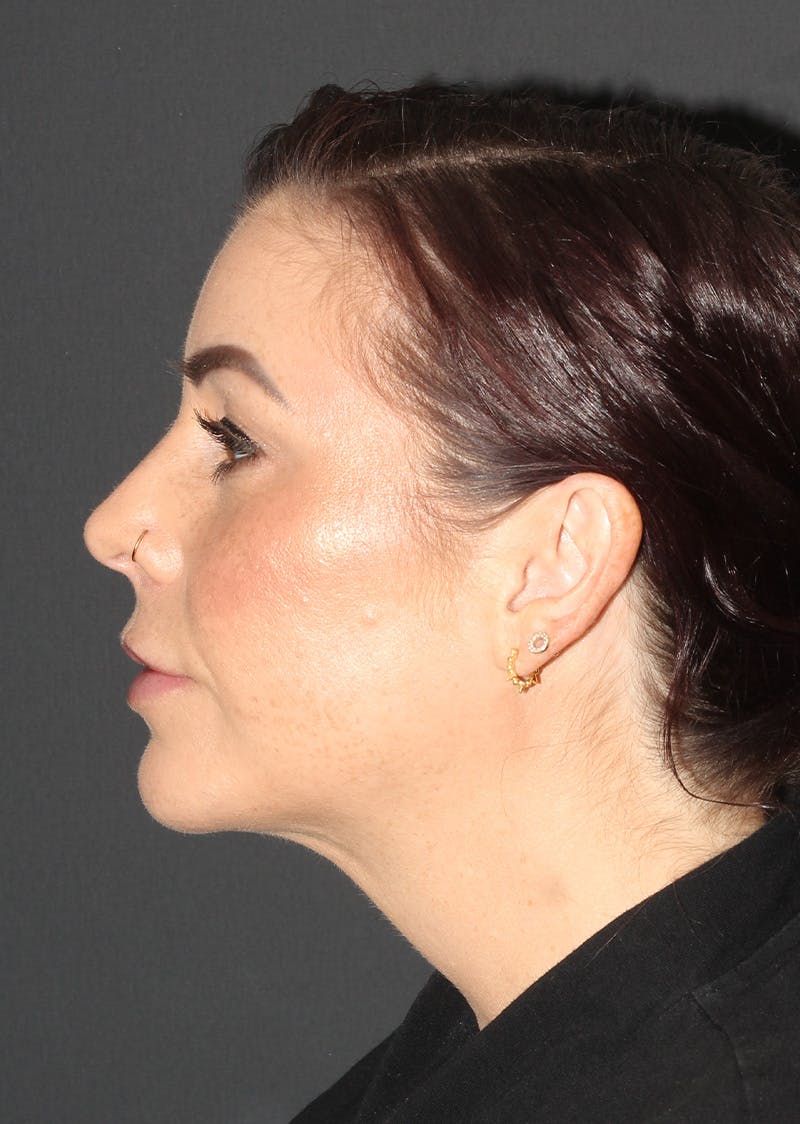 Facetite Before & After Gallery - Patient 325510 - Image 10