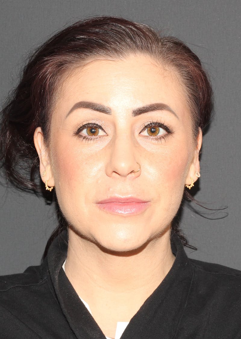 Facetite Before & After Gallery - Patient 325510 - Image 6