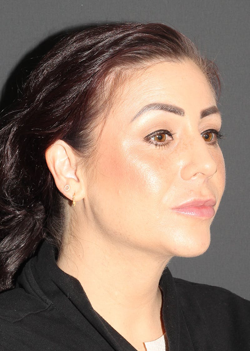 Facetite Before & After Gallery - Patient 325510 - Image 4