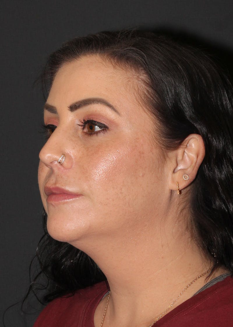 Facetite Before & After Gallery - Patient 325510 - Image 7
